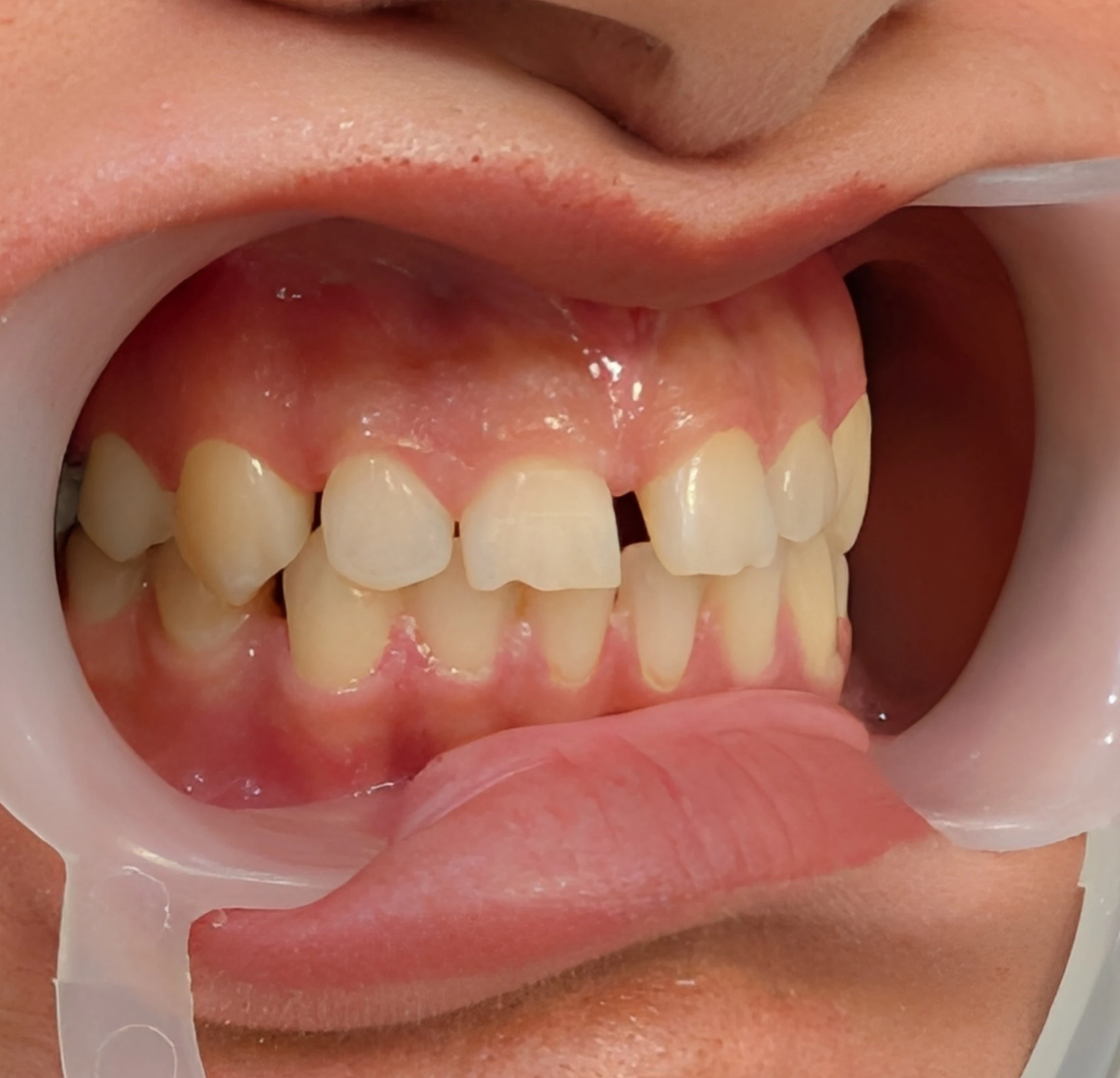 Diastema and space distribution in anterior teeth