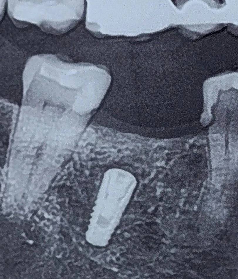 Deep implant placement in fresh socket; a prosthetic problem revealed later