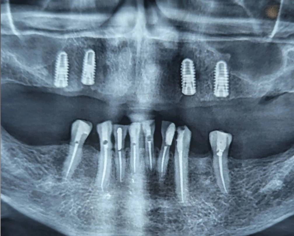 Lack of posterior occlusion; a hidden limitation for maxillary overdenture