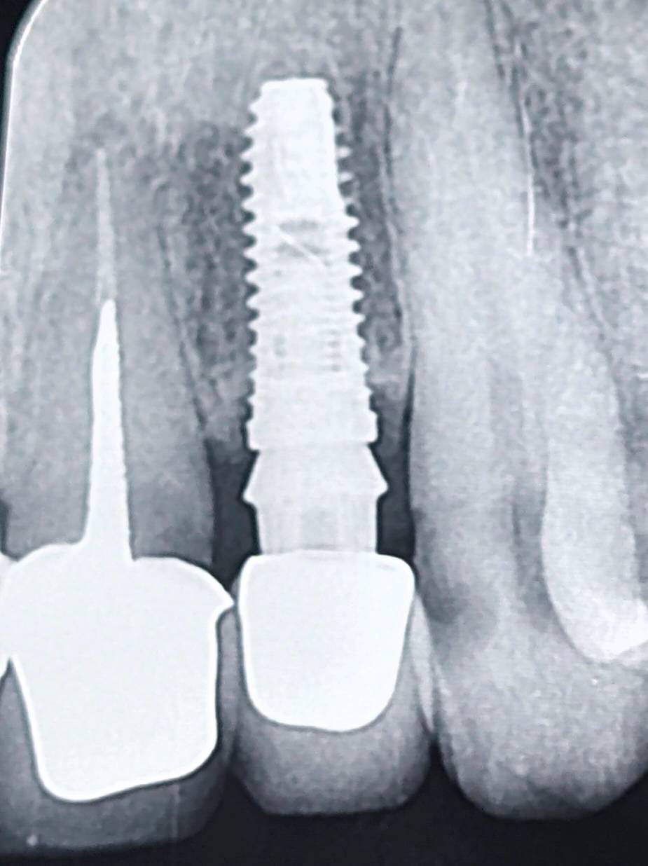Finish line discrepancy relative to crown margin; a late-revealing error