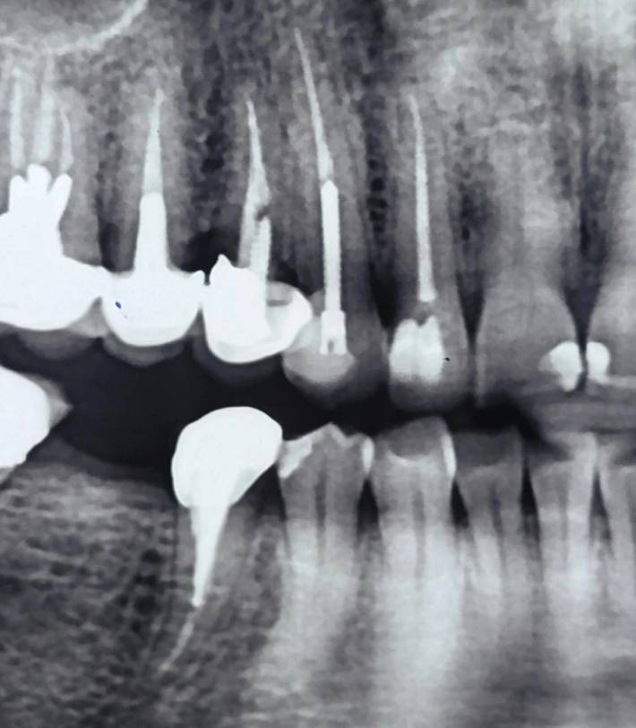 Panoramic radiograph; limited diagnostic value for structural decision-making