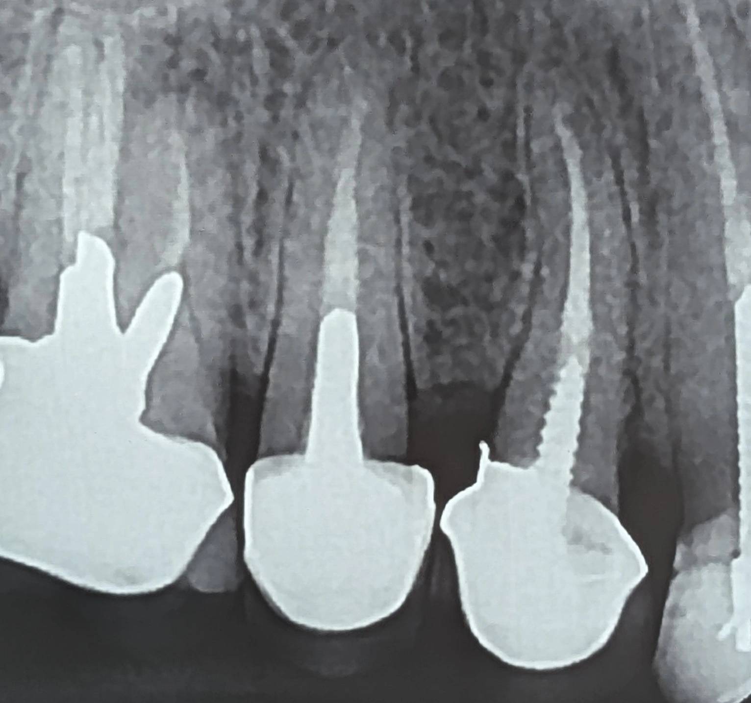 Periapical radiograph; improved visualization of root and surrounding structures