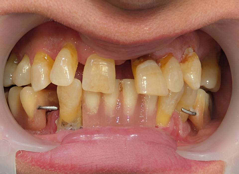 Composite veneer request in periodontally compromised anterior teeth