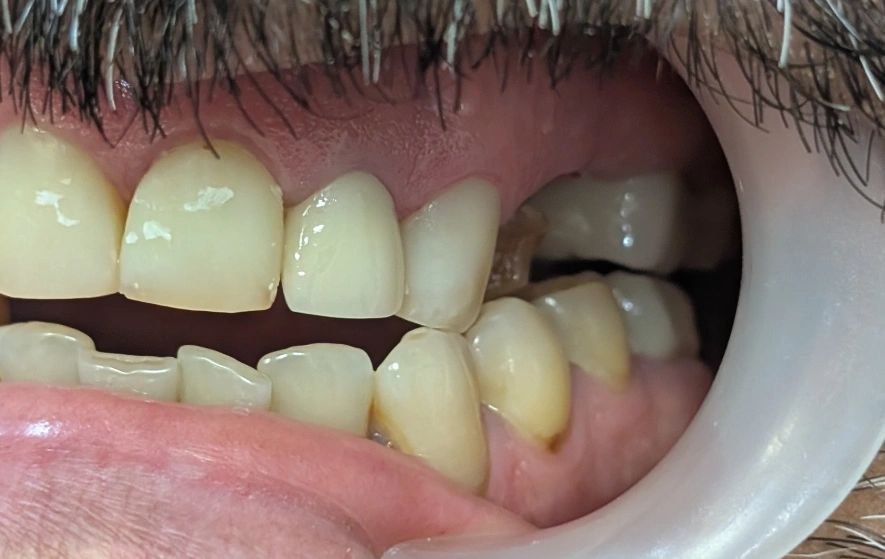 Asymmetric lateral guidance after single-unit crown restoration; canine rise vs group function
