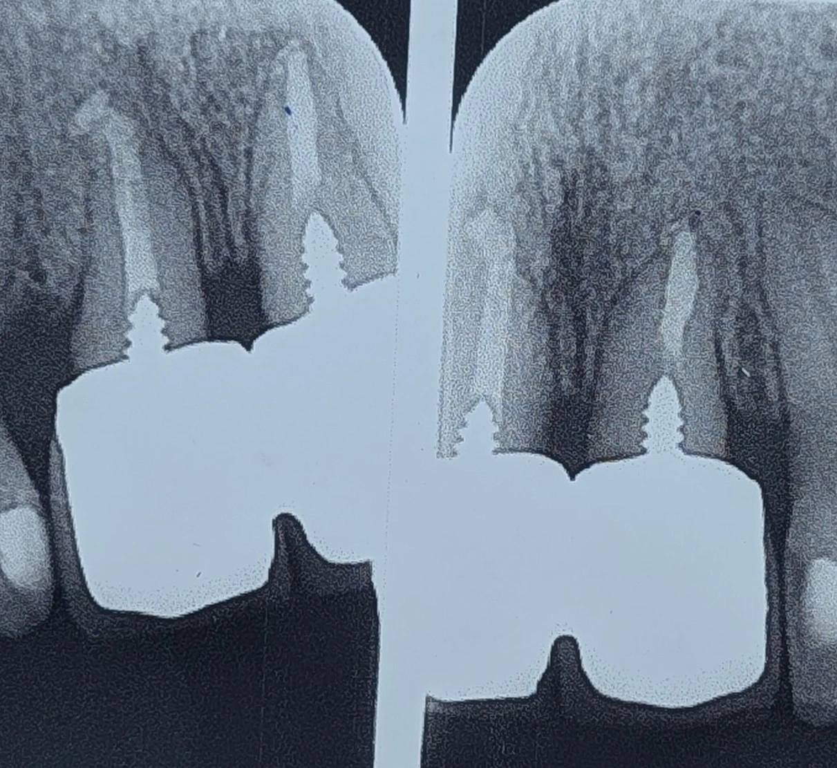 Crown lengthening on anterior teeth with short roots; bone loss and esthetic failure in the anterior zone