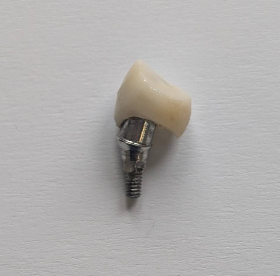 Referral implant case with repeatedly loose crown and poor prosthetic fit; deciding whether to continue treatment