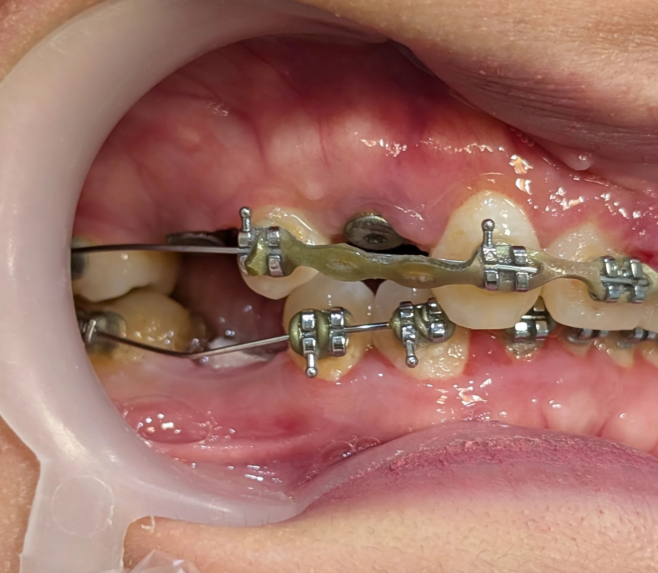 Space analysis for premolars