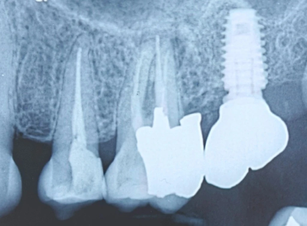 Periapical radiograph showing an endodontically treated molar with a significant distal overhang adjacent to an implant crown on the second molar, and a second premolar with three-wall ferrule