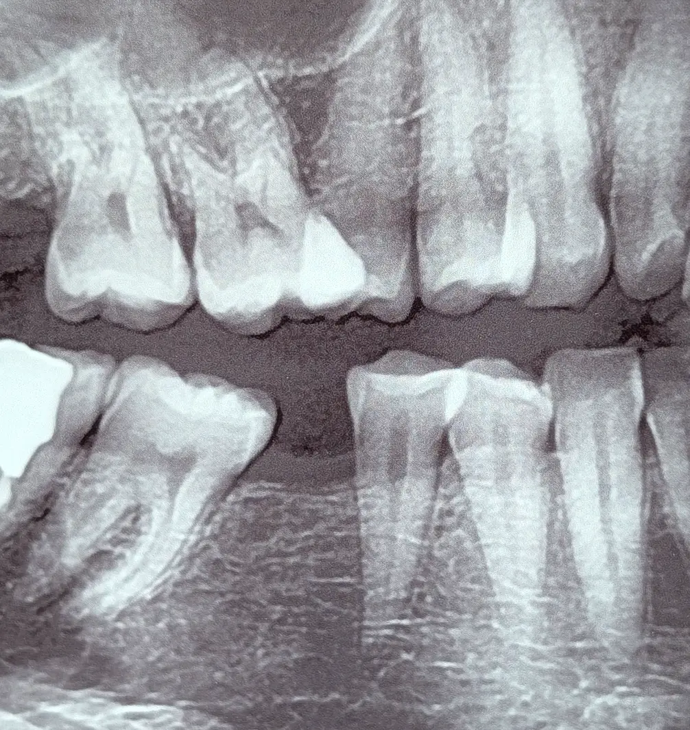 Long-standing mandibular molar loss