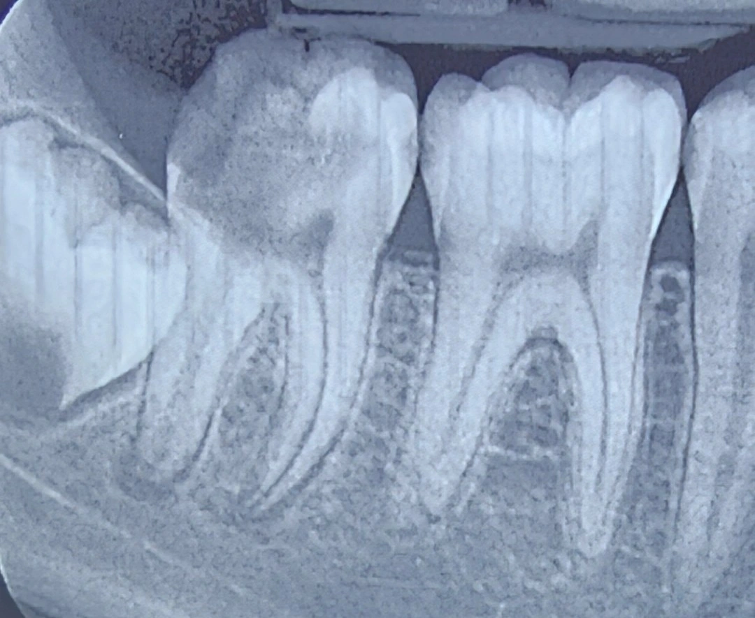 Periapical radiograph of the second molar in a 15-year-old patient, showing extensive coronal destruction with insufficient remaining structure for an adequate ferrule.