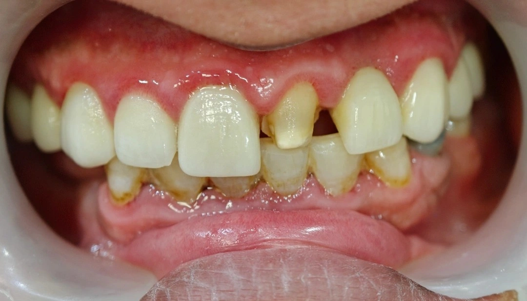 Intraoral view showing a heavily prepared maxillary left central incisor with exposed dentin, residual caries, and gingival inflammation, compounded by a lack of posterior support.