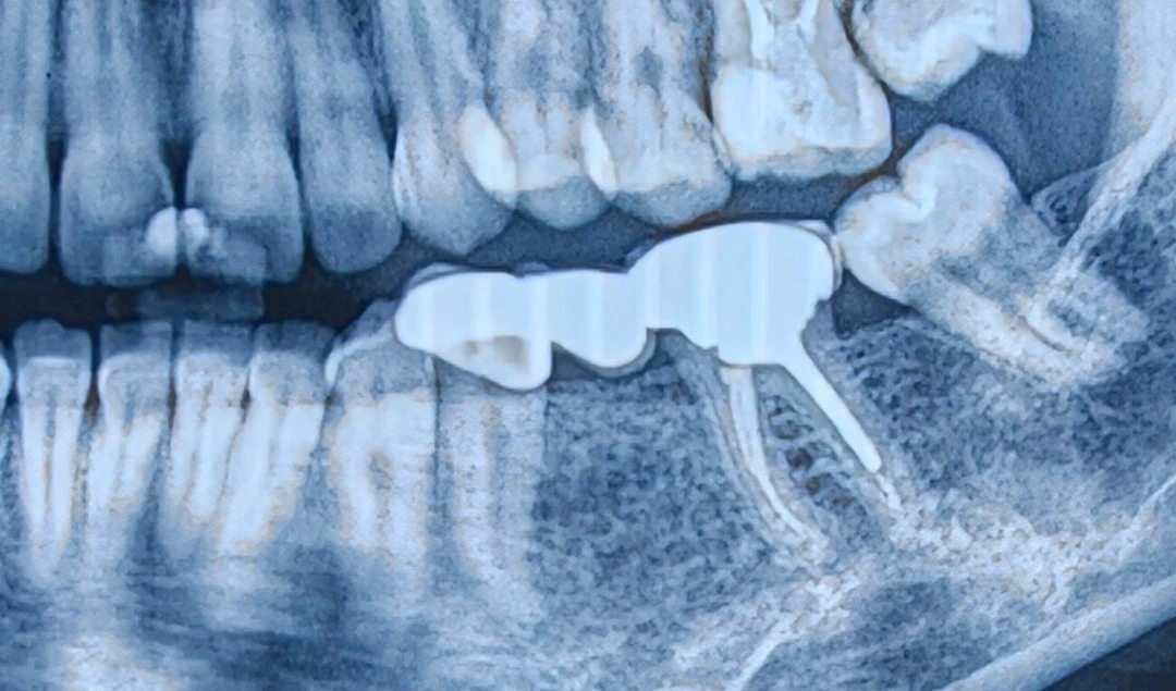 Cropped panoramic radiograph showing a three-unit PFM bridge on mandibular left teeth 4–6, with apparently acceptable seating on the posterior abutment and a flattened occlusal profile.