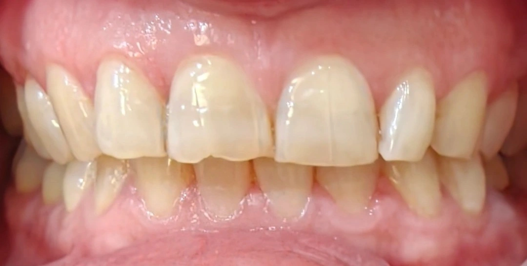 Close-up clinical photograph of yellowed maxillary and mandibular anterior teeth in occlusion, with irregular incisal edges.