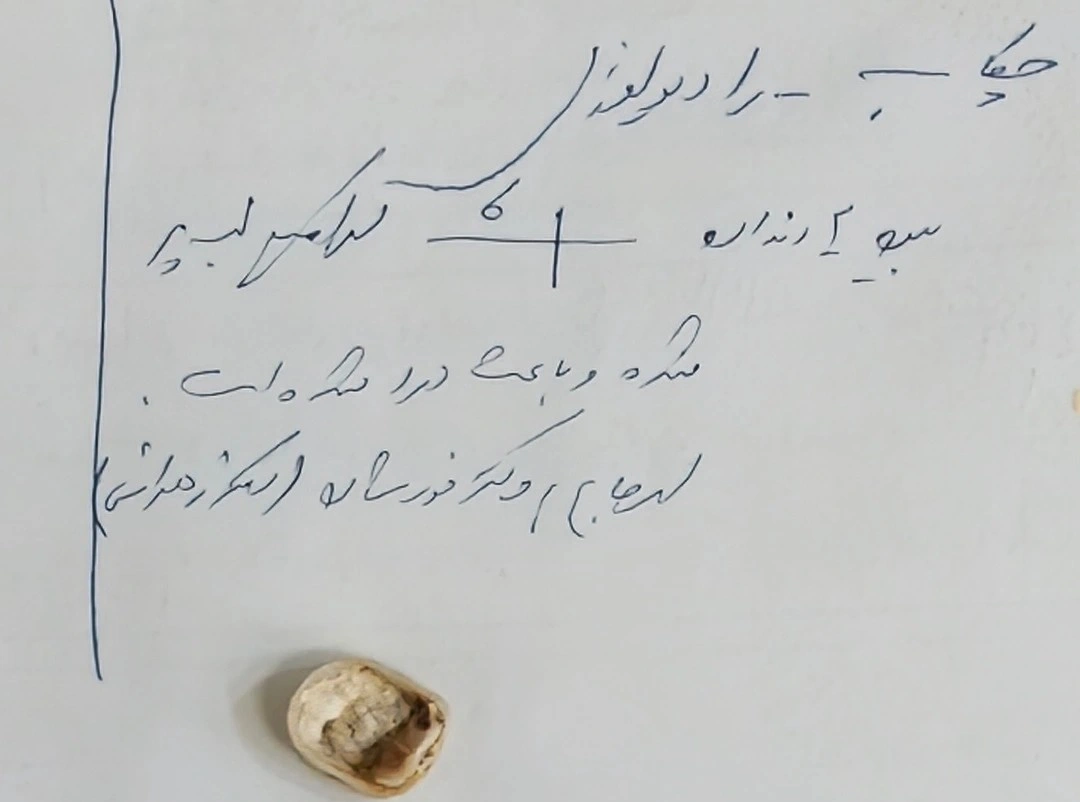 A crown that came off, showing a heavy build-up of cement on its palatal aspect, photographed beside the handwritten chart notes from the patient's earlier visits.