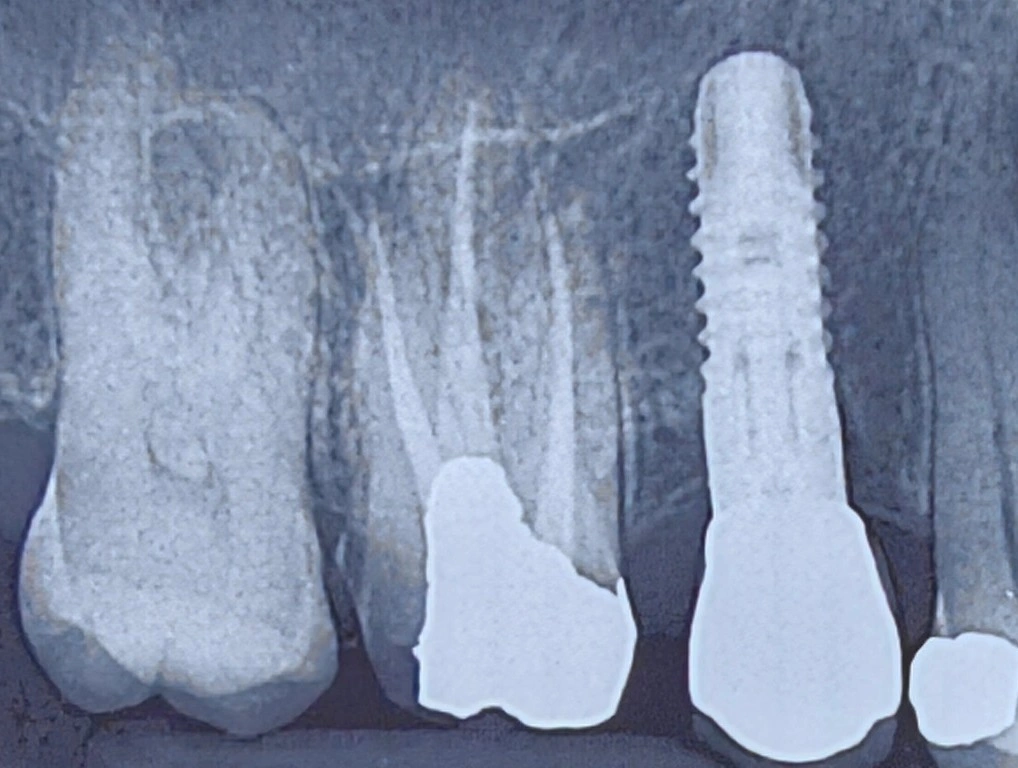 Periapical radiograph showing an implant at the second premolar site and deep proximal caries on both proximal surfaces of the first molar abutment.