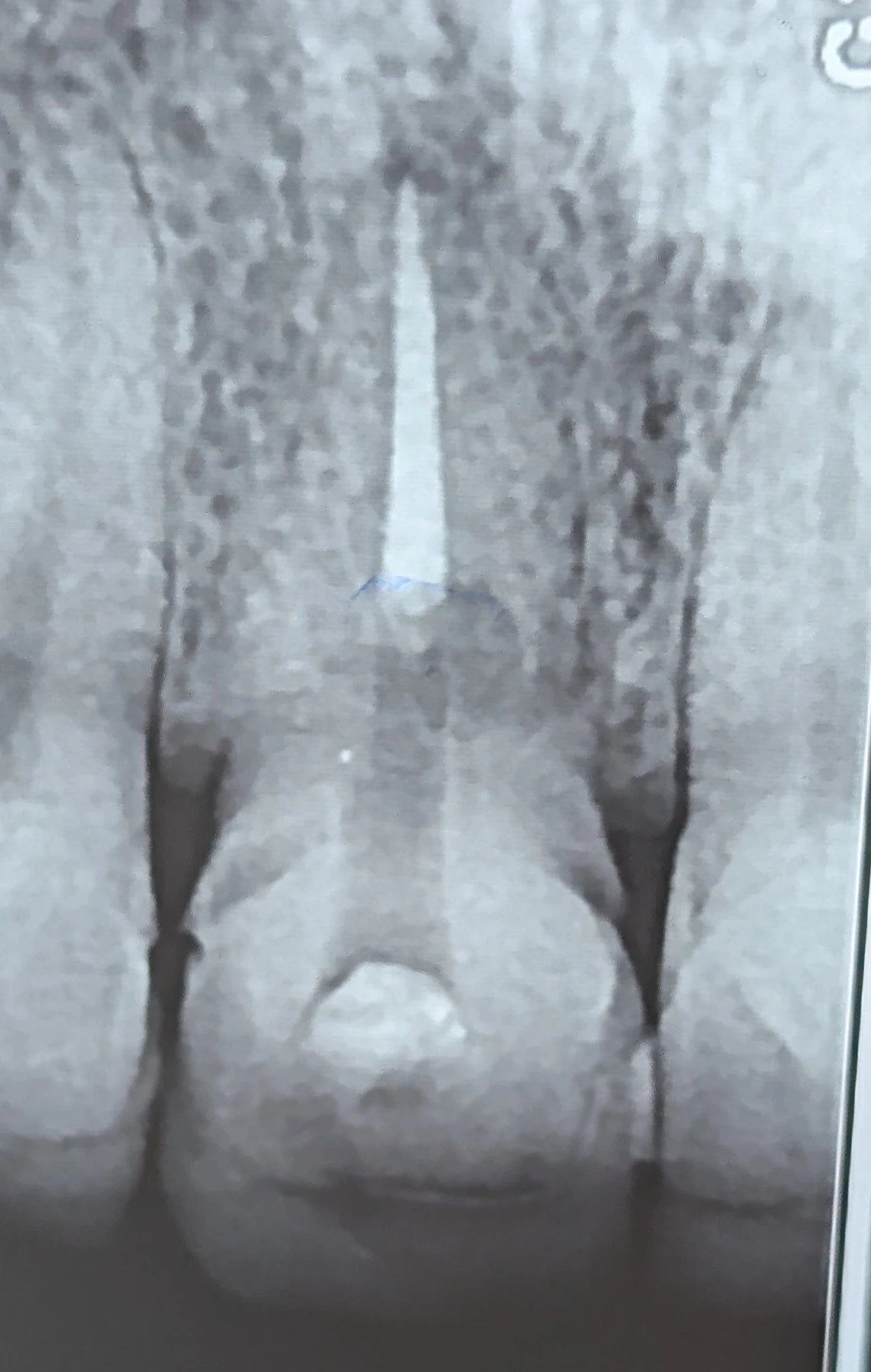 External cervical resorption in anterior tooth