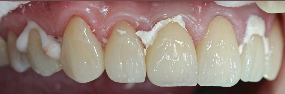 Intraoral view of maxillary crowns and veneers during cementation.