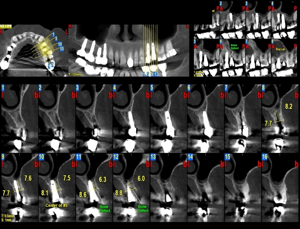 تصویر CBCT با مقاطع کراس‌سکشن ناحیه‌ی ۵ بالا سمت چپ و علامت نقص استخوانی باکال