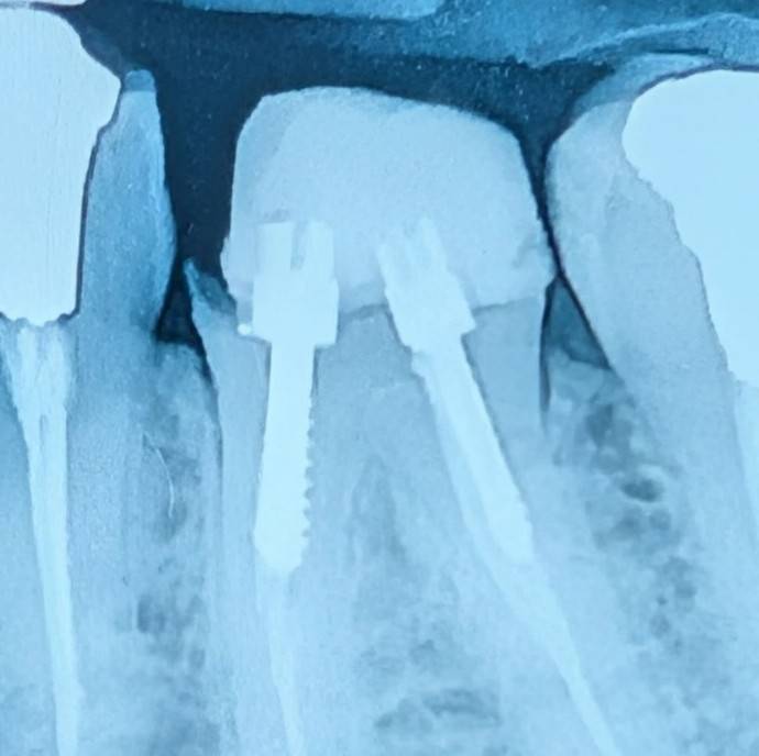 Ferrule importance case