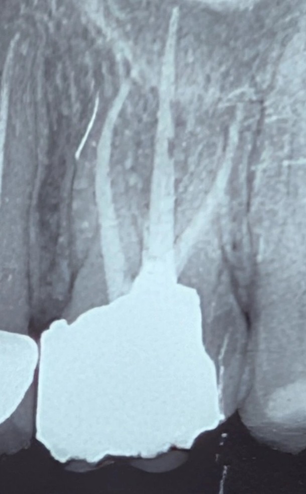 Interproximal restoration contour and biologic width case