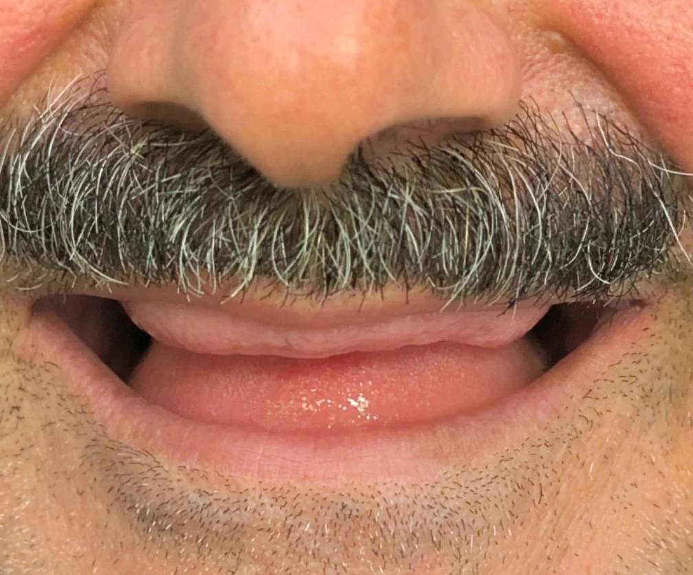 Excessive ridge display in removable prosthodontic planning case