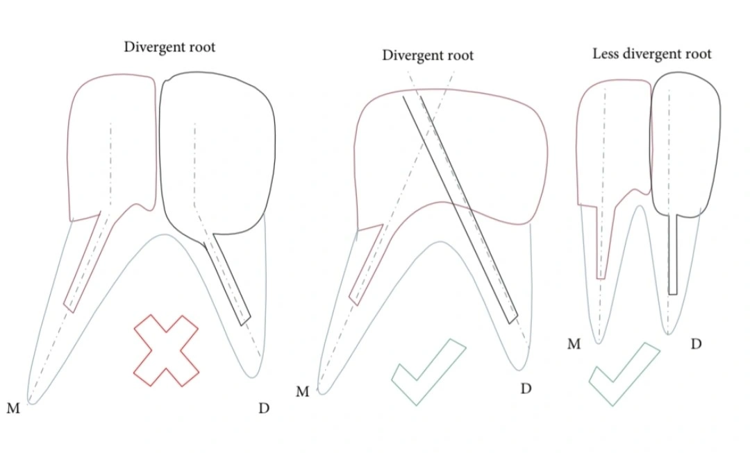 Diagram comparing two-piece post and core designs: an incorrect single-block cast post across two divergent molar roots, a multisection post and core with two independent paths of withdrawal, and a single cast post and core with a less divergent auxiliary post.
