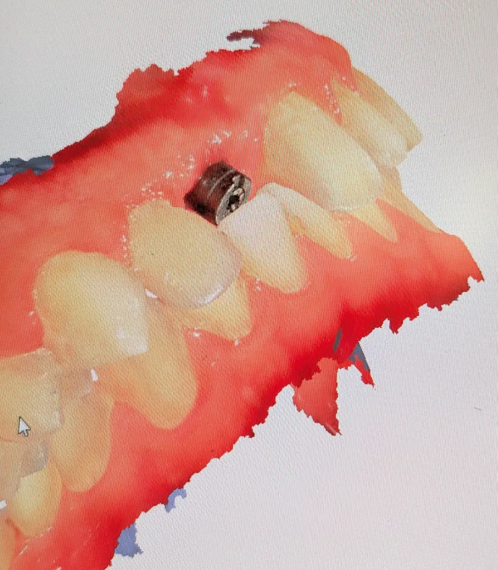 ایمپلنت سانترال در بیمار دیپ بایت با محدودیت فضا