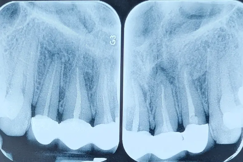 ارزیابی دندان زیر روکش اسپلینت شده