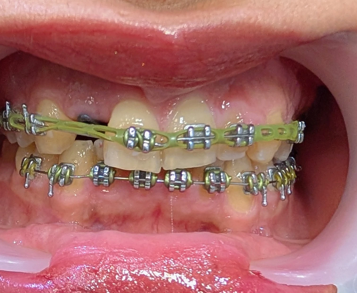 ارزیابی فضای بازسازی با روکش موقت و طراحی دیجیتال