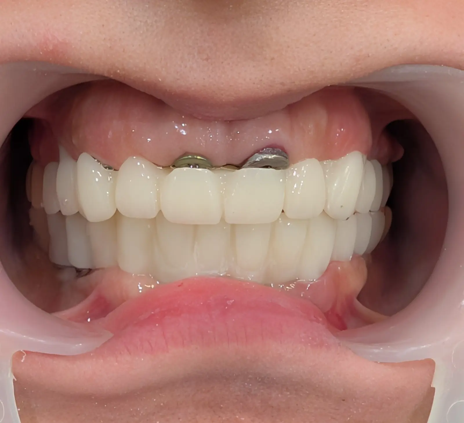 Illustration of the cross-mounting stages and full mouth rehabilitation