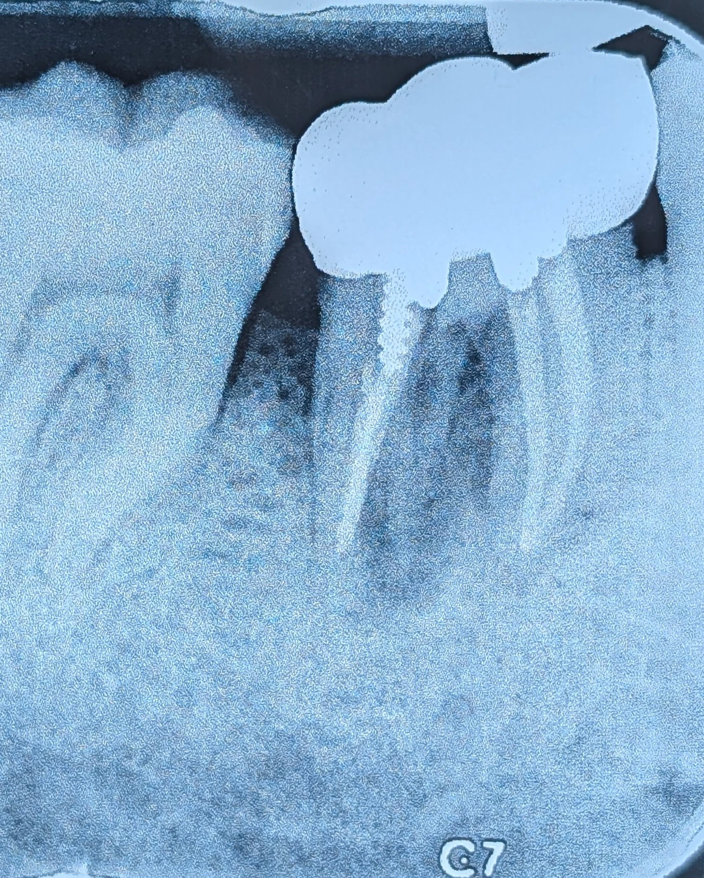 طراحی کور و پست با درنظرگرفتن امکان درمان مجدد ریشه