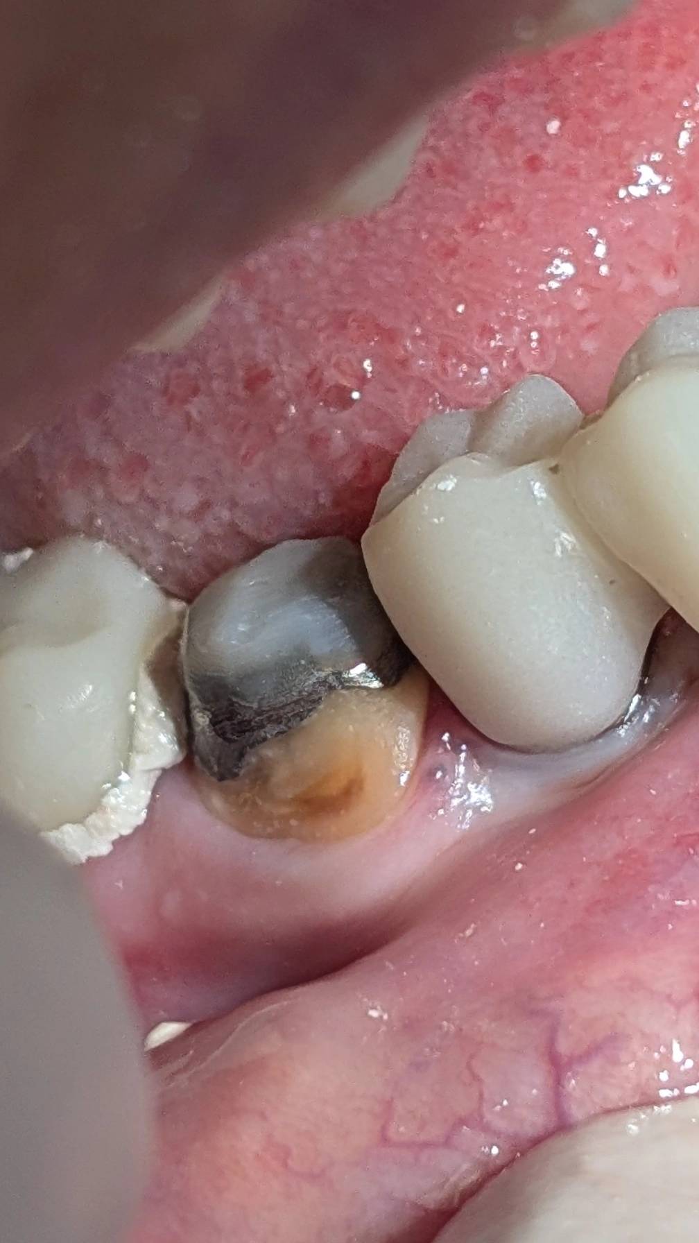 باند کامپوزیت به پست و کور فلزی