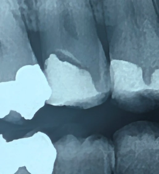 رادیولوسنسی منظم زیر ترمیم و تمایز آن از پوسیدگی ثانویه