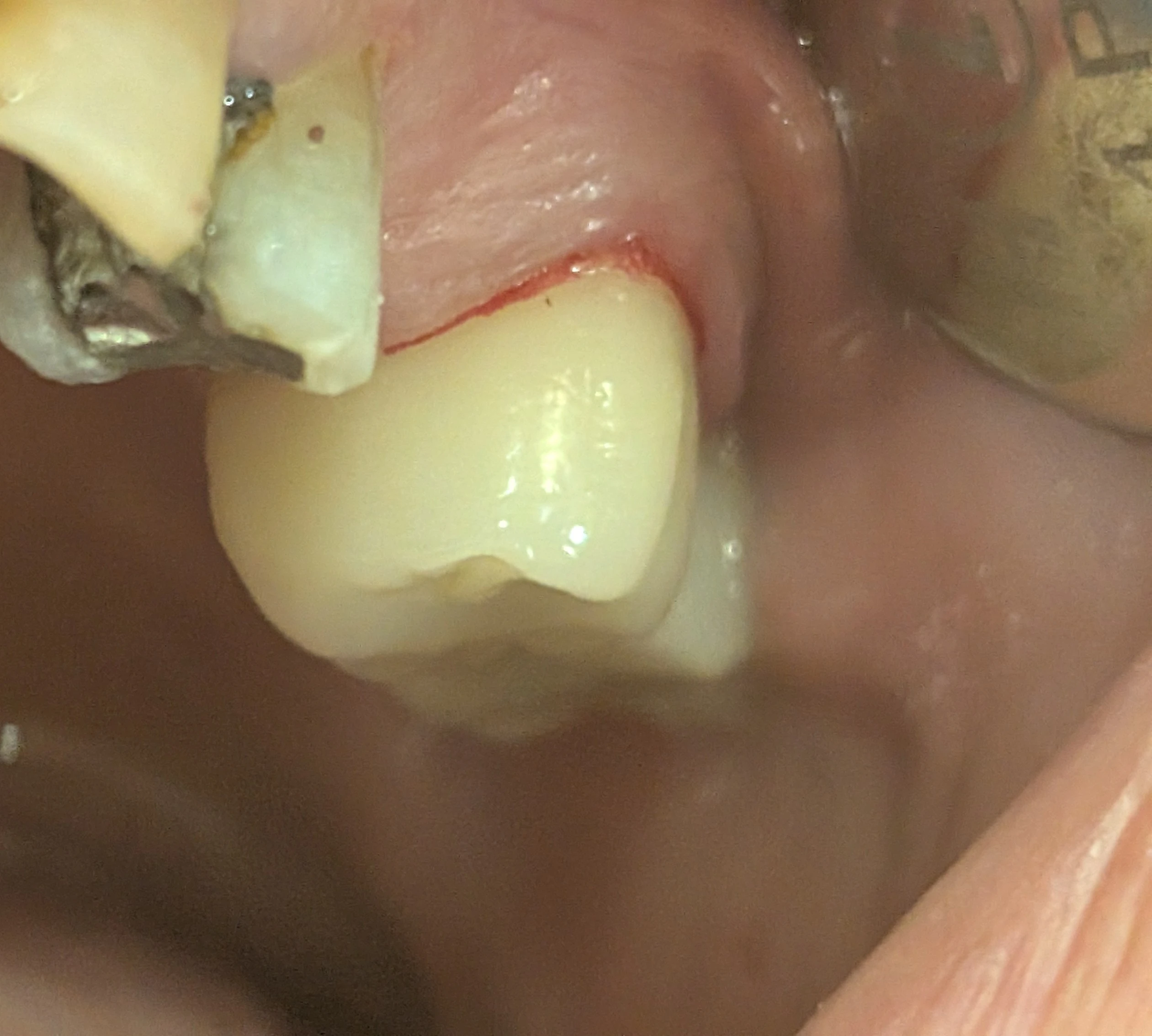 وقتی دندان مجاور نیست، روکش بزرگ‌تر به نظر می‌رسد