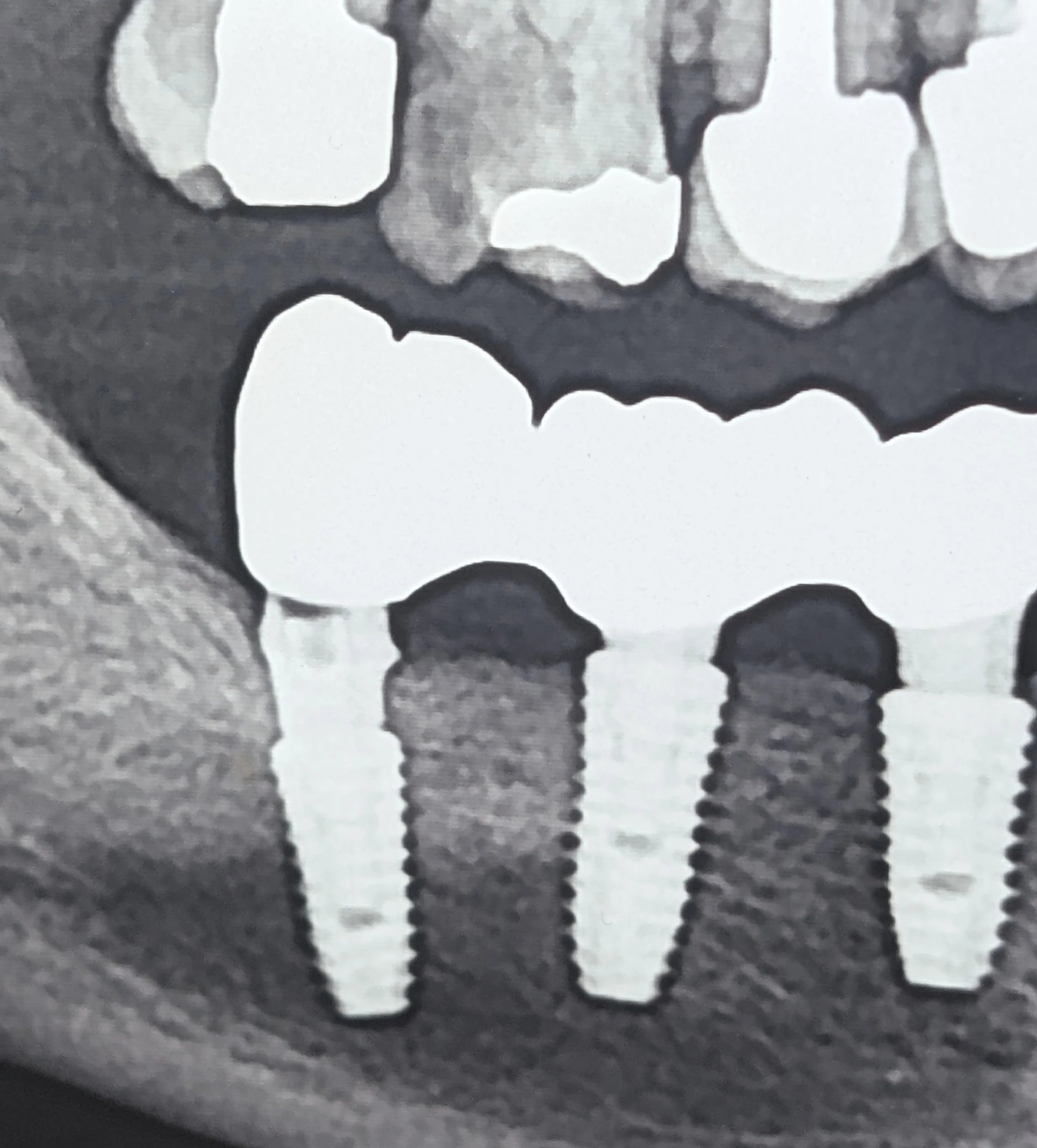 اهمیت انتقال صحیح اطلاعات Scan Body و فایل کتابخانه‌ای در پروتزهای ایمپلنتی دیجیتال