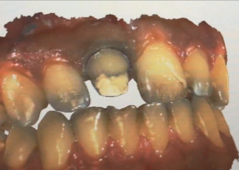 پوشاندن کور قدامی با اوپکر