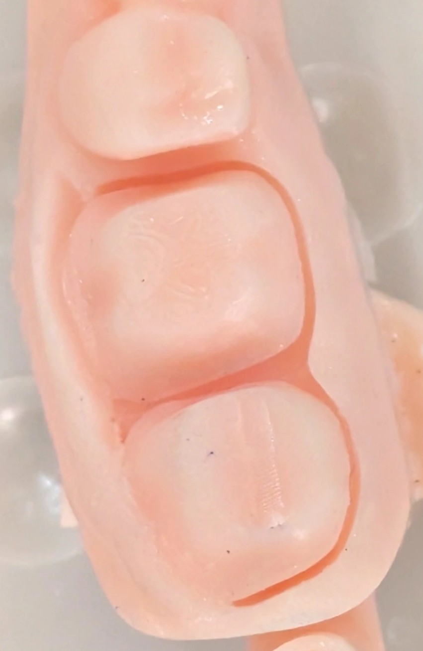 دو دندان تراش خورده کنار هم