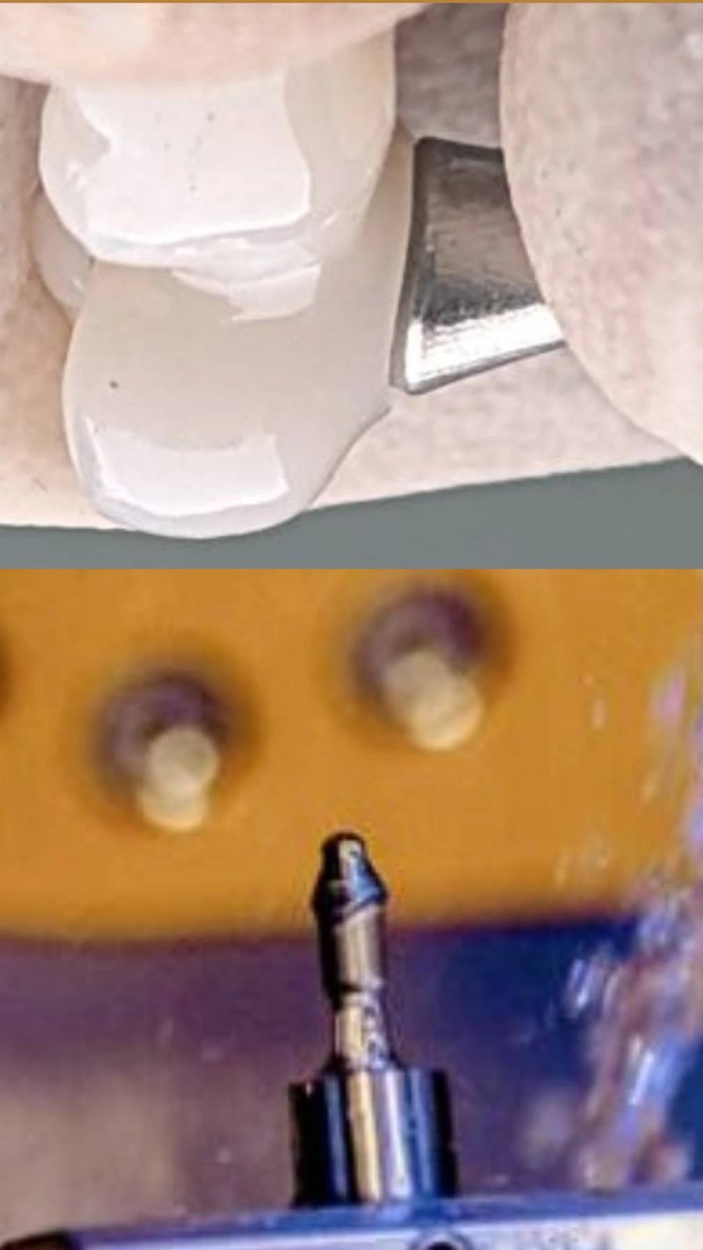 اباتمنت پریمیل ایمپلنت