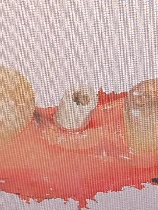 اسکن‌بادی و Ti-base ایمپلنت دیجیتال