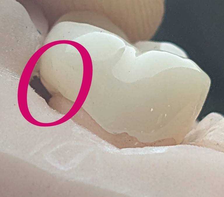 کانتور مقعر در روکش سرامیکی و امبراژور