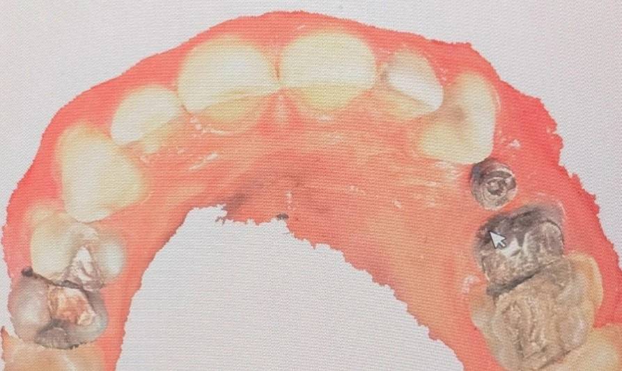 گسترش محدوده اسکن برای دستیابی به مرجع آناتومیک بهتر در طراحی تاج ایمپلنت