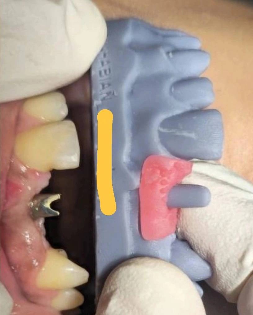 کوتاه دیده شدن اباتمنت در دهان و تمایز خطای جهت از خطای ارتفاع