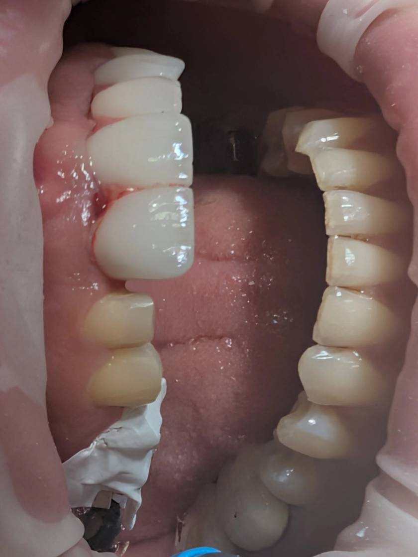 ایزولاسیون مرحله‌ای با نوار تفلون در باندینگ چند واحدی