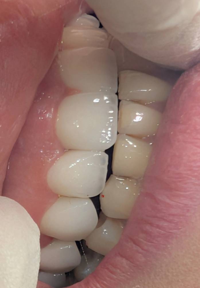 پریدگی دیستال لمینیت ۲؛ تداخل فانکشنال پنهان در حرکات پروتروزیو