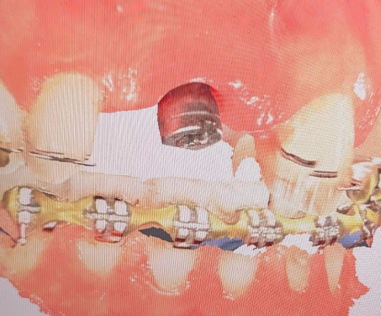 ایجاد مرجع پروتزی ثابت برای هدایت اصلاح ابعاد و فضاها در درمان بین‌رشته‌ای