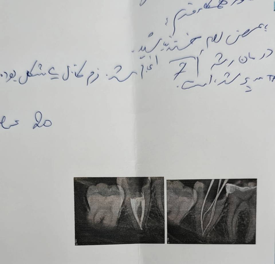بازتعریف بازسازی پروتزی در دندانی که کانال آن دیگر نقش گیرنده پست ندارد