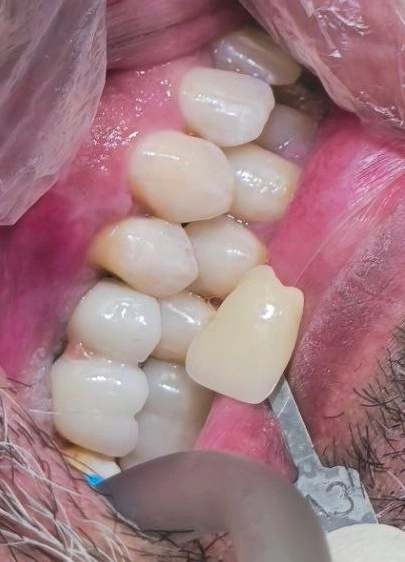A posterior implant crown with a short buccal cusp in the smile zone; gaining the needed space from enameloplasty of the supraerupted opposing tooth rather than shortening the visible cusp