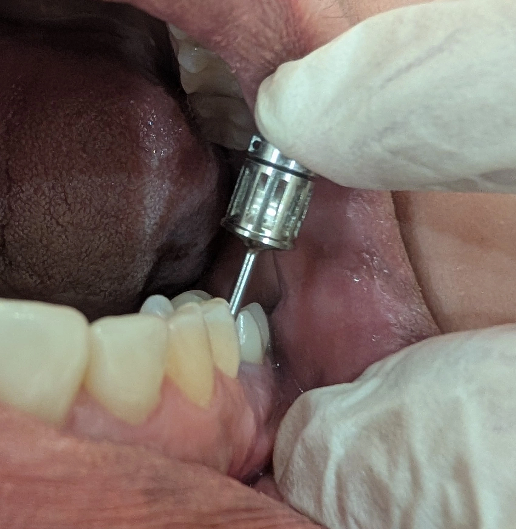 A posterior implant crown on a fixture tilted unfavorably in the buccolingual direction; building a retrievable crown and reducing the horizontal load in group-function occlusion without disturbing the buccal cusp form