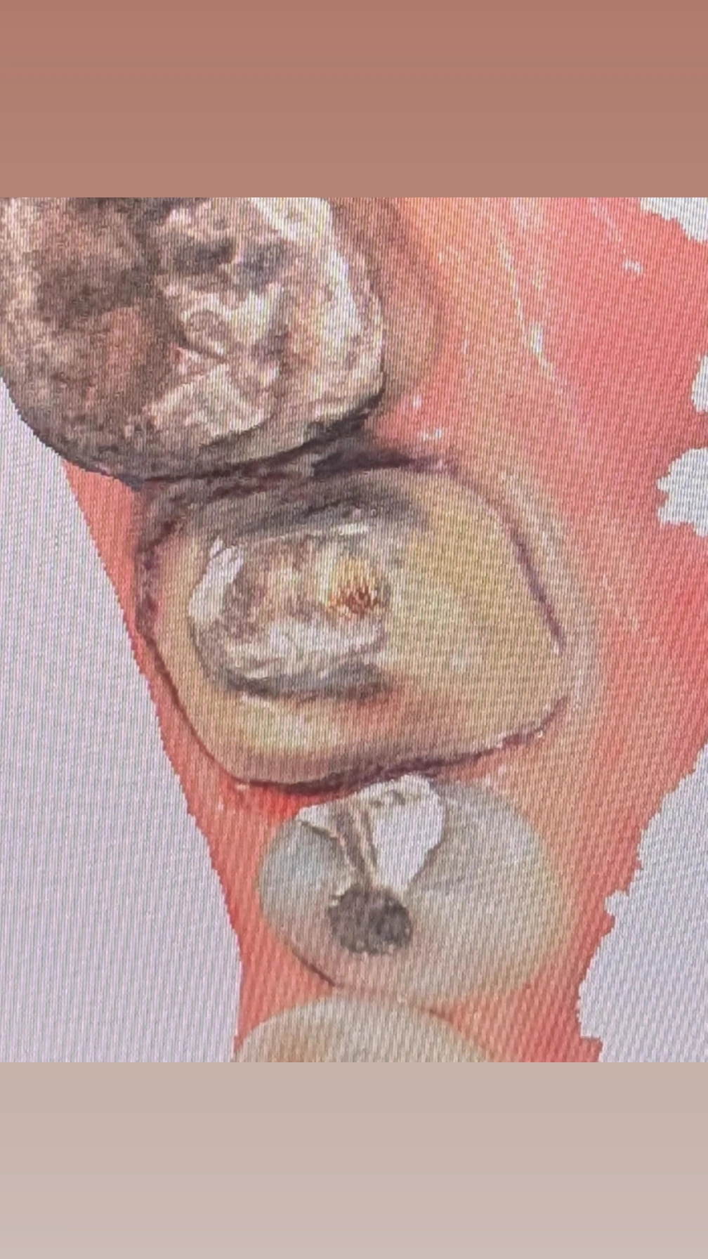 An amalgam-restored tooth being prepared for a crown; during preparation, residual carious tissue is found in the proximal area, and that carious area is incorporated into the proximal box of the crown preparation instead of removing the whole amalgam