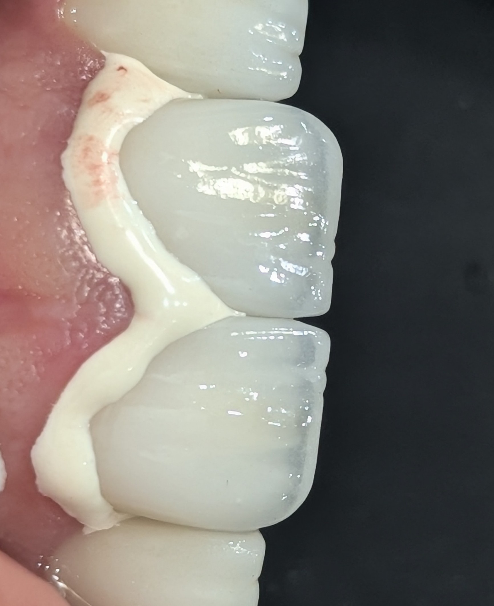 تصویری شماتیک از تفاوت رنگ در روکش‌های سرامیکی بین سمان موقت و سمان دائم